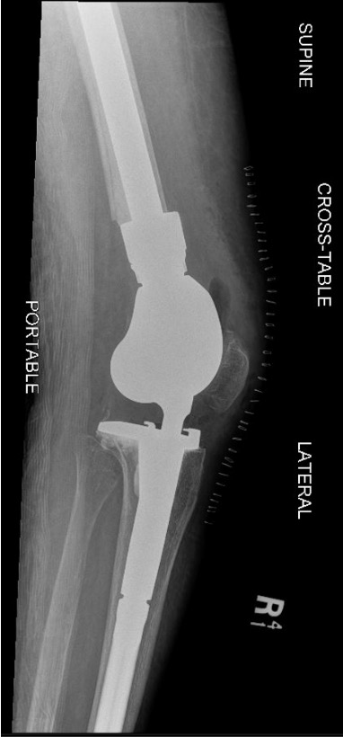 Distal Femoral Replacement 4